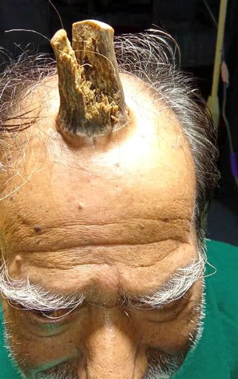 Surgeons Remove Four Inch Devil Horn From Farmers Head Ladbible