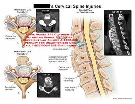 Amicus Illustration Of Amicus Injury Cervical Spine Central Disc Herniation Ct Anterolisthesis