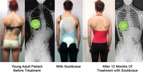 Scoliosis Spine And Scoliosis Clinic