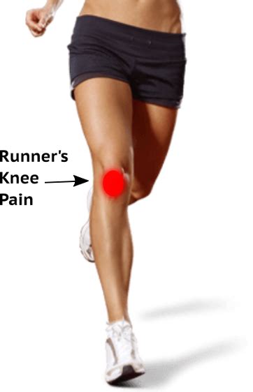 Anterior Knee Pain Aka Runners Knee — Brookvale Physio Hprs Physio