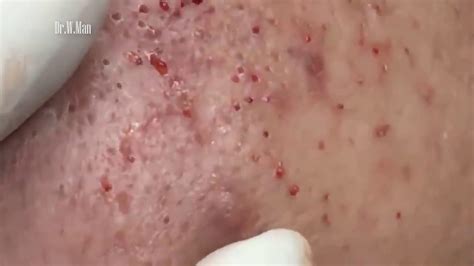 We apologize for any inconvenience. Remove Big Acne Pimples Blackhead Popping - Blackhead ...