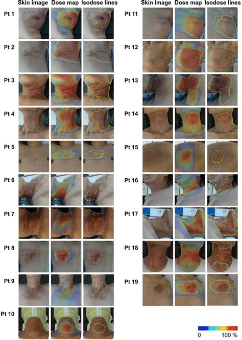 Visualized Dose Distribution On The Skin Surface Image Of Radiation
