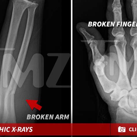 Do X Rays Always Show Broken Bones Whadoq