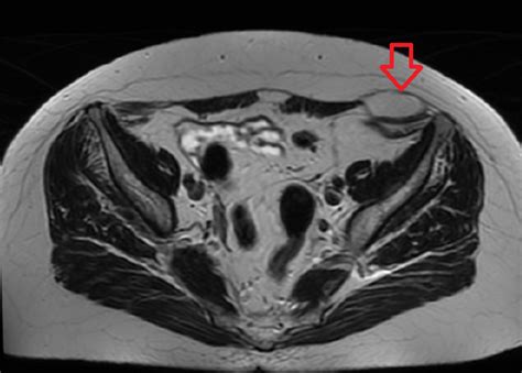 Spigelian Hernia Symptoms Diagnosis And Recovery