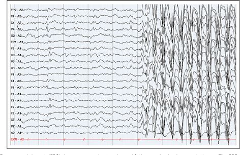 Figure 1 From Clinical Significance Of Incidental Rolandic Spikes In