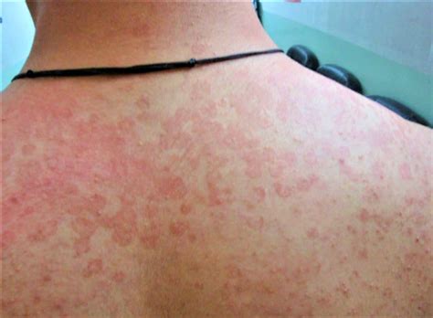 Tinea Versicolor Causes Signs Symptoms Treatment And Remedies