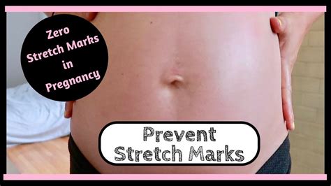 Preventing Stretch Marks In Pregnancy Tips And Tricks To Avoid And
