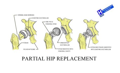 Hip Replacement Types Hip Replacement Experience Hip Replacement
