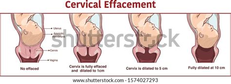 vector cervical effacement dilatation during labor stock vector royalty free 1574027293
