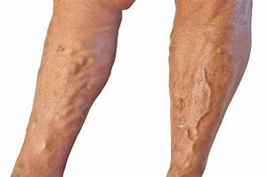 What is Venous Return? (with pictures)  Heart and Circulation Varicose Veins