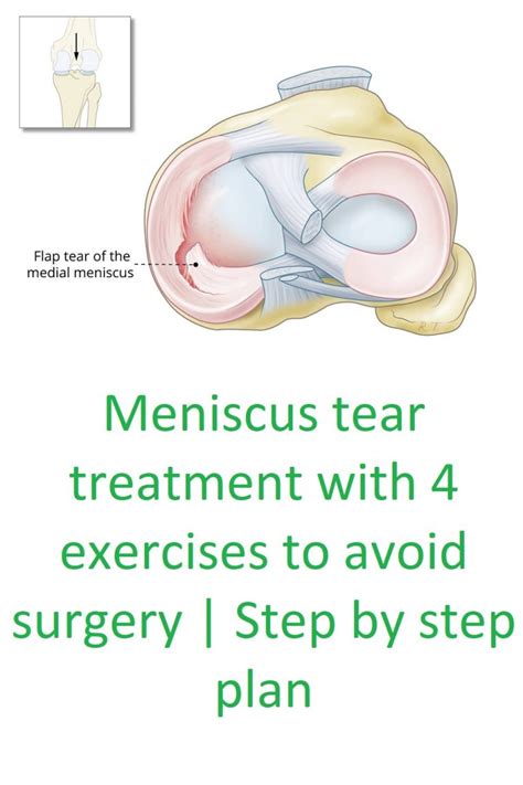 Meniscus Tear Cause Symptoms And Treatment With Exercises