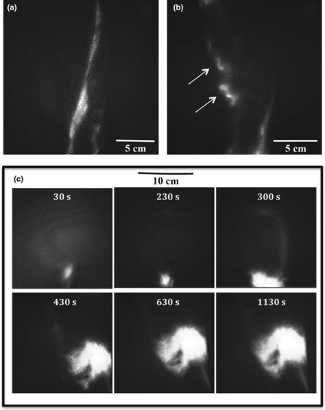 Morphological Lymphatic Abnormalities During Nirf Imaging A Still