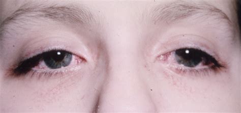 Ataxia Telangiectasia Hereditary Ocular Diseases
