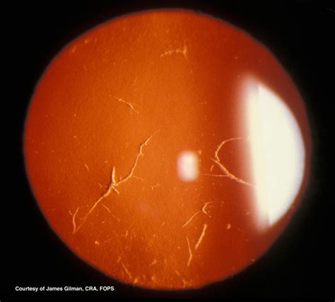 Lattice Corneal Dystrophy Statpearls Ncbi Bookshelf