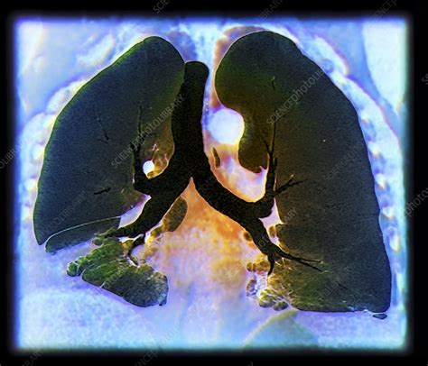 Kaposis Sarcoma Of The Lung Ct Scan Stock Image C0132190