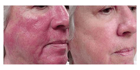 Rosacea Laser Treatment In Surrey Rhinophyma And Vascular Lesions