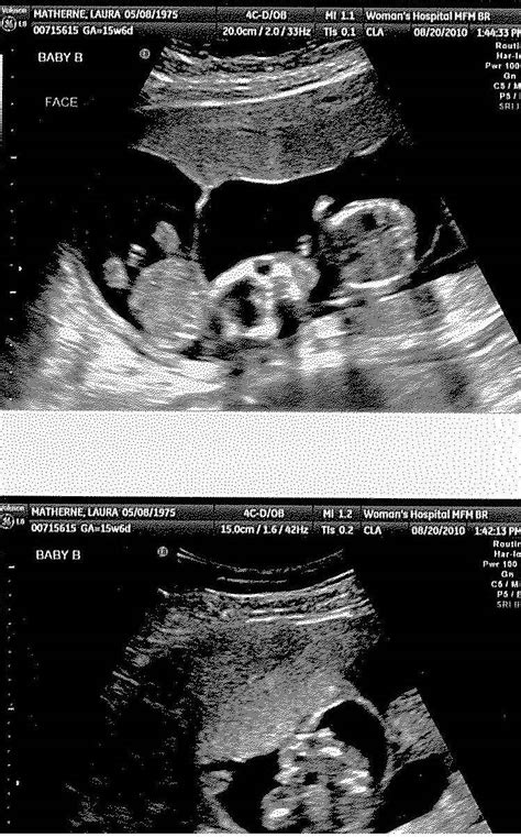 The Matherne Quads 16 Week Ultrasound Baby B Its A Boy