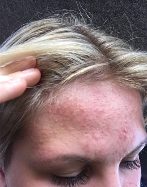 Bumps Forehead General Acne Discussion Forum