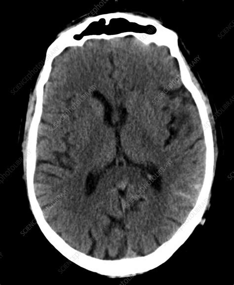 Subarachnoid Haemorrhage CT Scan Stock Image C Science Photo Library