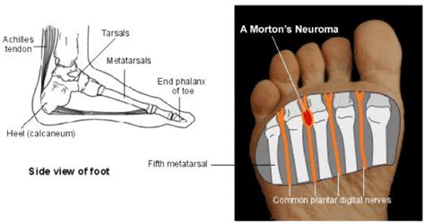 Mortons Neuroma Treatment And Surgery Tingling Feet Footcentregroup