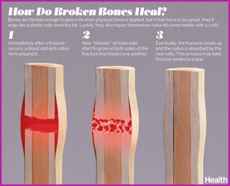 How Do Broken Bones Heal Esguince Enfermería Y Huesos