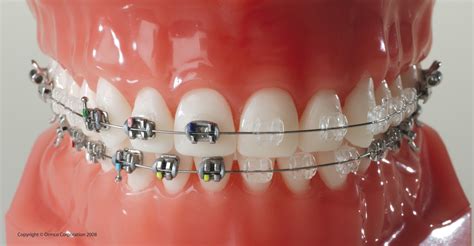 Bei festen zahnspangen lassen sich unterschiedliche arten von gummis einsetzen. unsichtbare Zahnspangen - Praxis für Kieferorthopädie ...