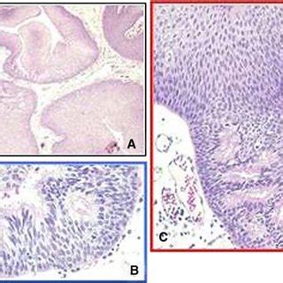 Development Of A Hpv Induced Squamous Cell Papilloma In Laryngeal