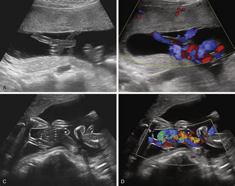 Ultrasound Evaluation Of The Placenta Membranes And Umbilical Cord