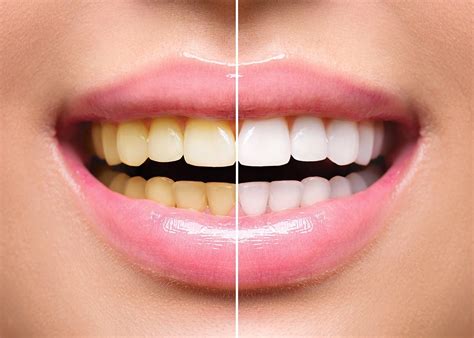 Teeth Whitening Mandurah Platinum Smile Dentist Mandurah