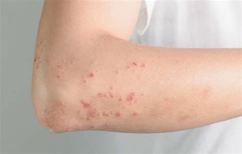 10 Serious Conditions That Rashes And Hives Can Indicate Things Health