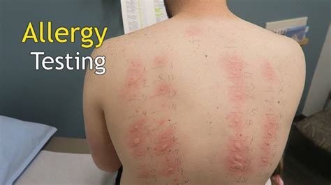 Taking A Test Can Help You Find Skin Allergy Triggers News Room