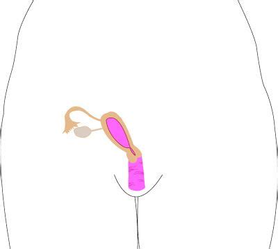 Mullerian Anomalies Unicornuate Uterus This Is What I Have Only It S