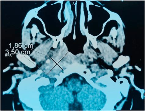 Axial Contrast Enhanced Ct Soft Tissue Window Of The Paranasal Showed