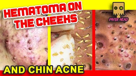 Big Cystic Acne Blackheads Extraction Blackheads Whiteheads Removal