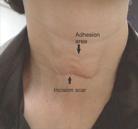 Postthyroidectomy Adhesion A Noticeable Scar And Marked Sunken