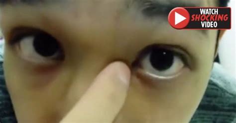 Stomach Churning Moment Pus Oozes From Mans Eye After Cyst Popped On