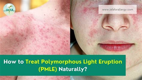 How To Treat Polymorphous Light Eruption Pmle Naturally