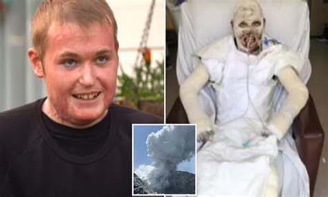 White Island Eruption Survivor Who Suffered Burns To Per Cent Of His Body Shares His Story