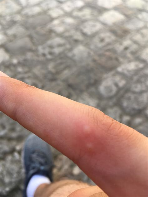 Mosquito Bites On Fingers Like These Mildlyinfuriating