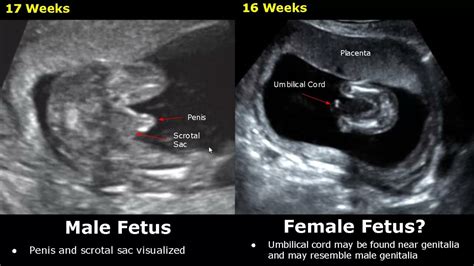 Fetal Gender Determination On Ultrasound Determining The Sex Of A Baby On USG Babe Girl YouTube