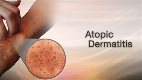 33 Eczema Atopic Eczema Types Of Skin Diseases