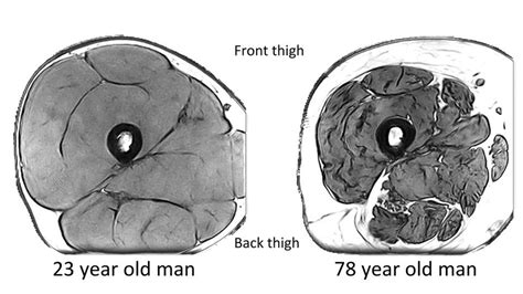 Muscle Loss In Old Age Linked To Fewer Nerve Signals Bbc News