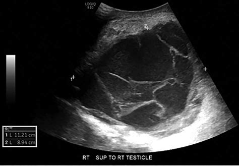 Scrotal Ultrasound Complex Septated Cystic Lesion On The Right Side Of Hot Sex Picture