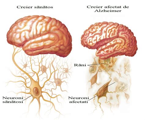 Alzheimer Boala Referate