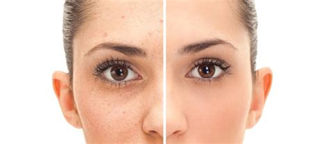 Causes And Symptoms Of Dark Spots And How To Treat Them Women Daily