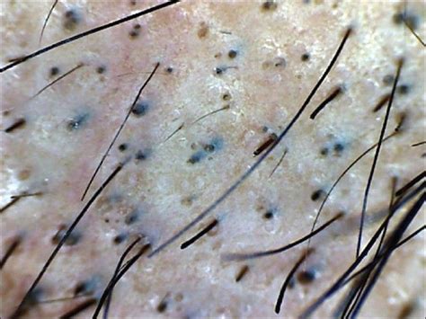 Black Dot Alopecia Dermatophytes Cause Hair Breakage Hair Loss