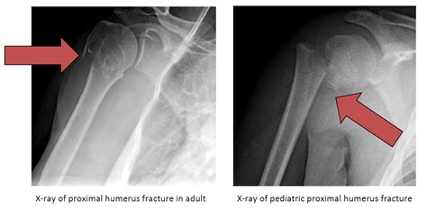 Proximal Humerus Fracture Broken Shoulder Orthopaedic