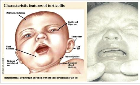 congenital muscular torticollis and positional plagiocephaly semantic scholar