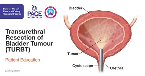 Transurethral Resection Of Bladder Tumour Turbt