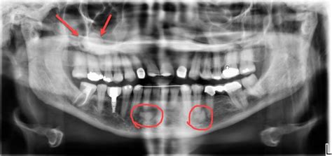 Dental X Rays Why Which And When Charles D Payet Dds Pa